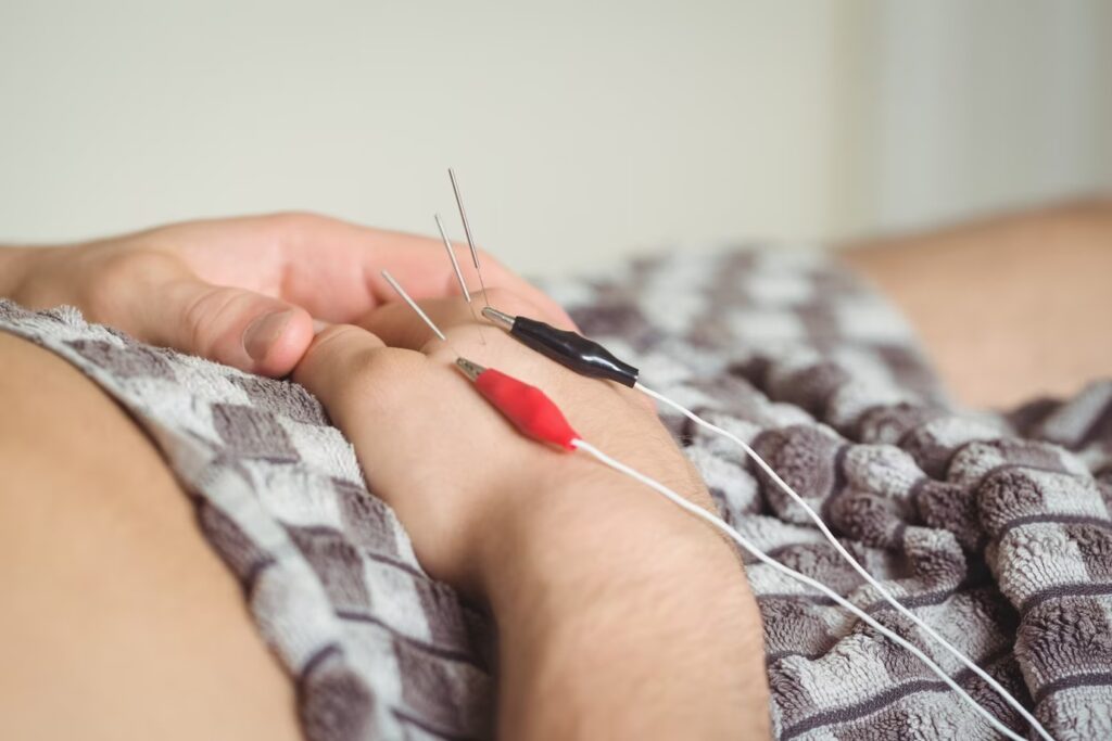 Finding Relief through Dry Needling: A Comprehensive Guide