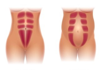 Healing the Divide: Treating Diastasis Recti with Physiotherapy